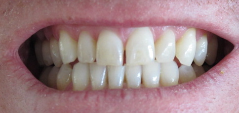 O perborato de sódio, presente no sabão em pó, também é usado em produtos odontológicos para o clareamento dos dentes (Foto: Flickr / torbakhopper / CC BY 2.0)