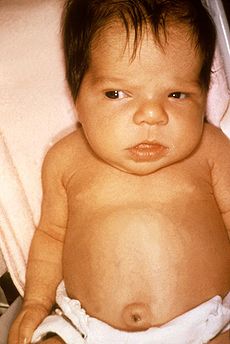 Esse é um bebê com icterícia neonatal. Vê como ele é um pouco amarelado? (Imagem: Domínio Público)